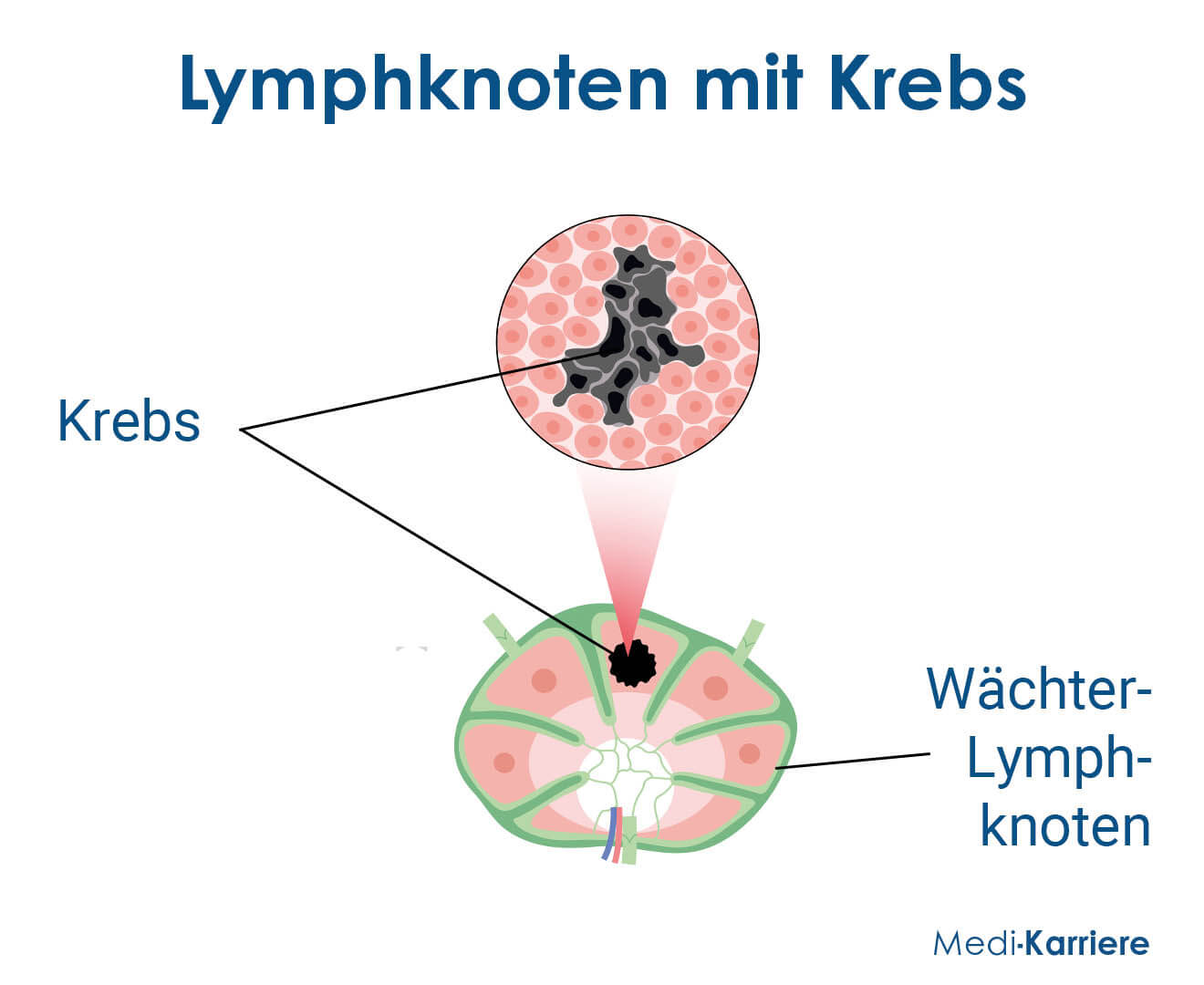 Lymphnoten Beschriftet Krebs