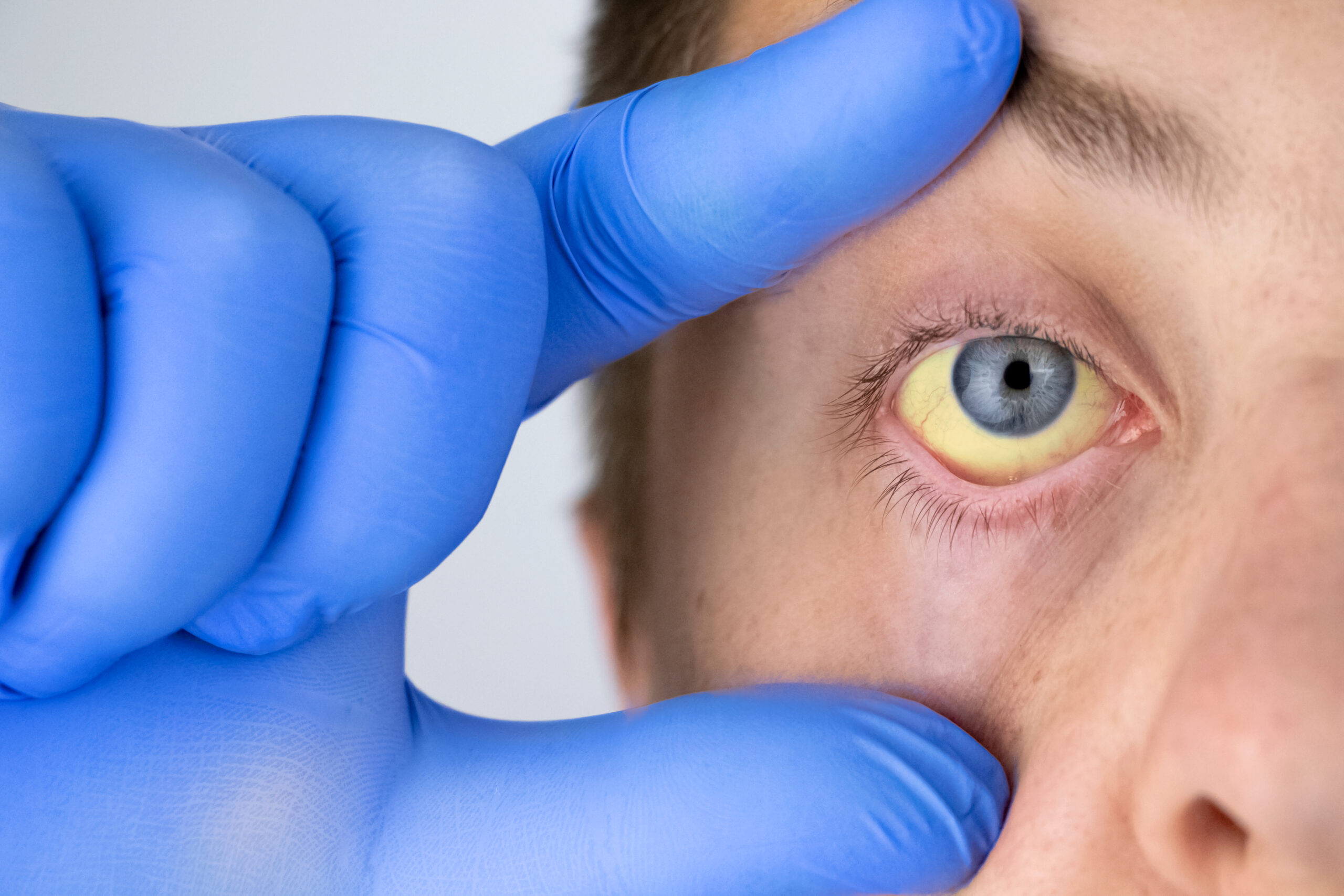 The,Yellow,Color,Of,The,Male,Eye.,Symptom,Of,Jaundice,