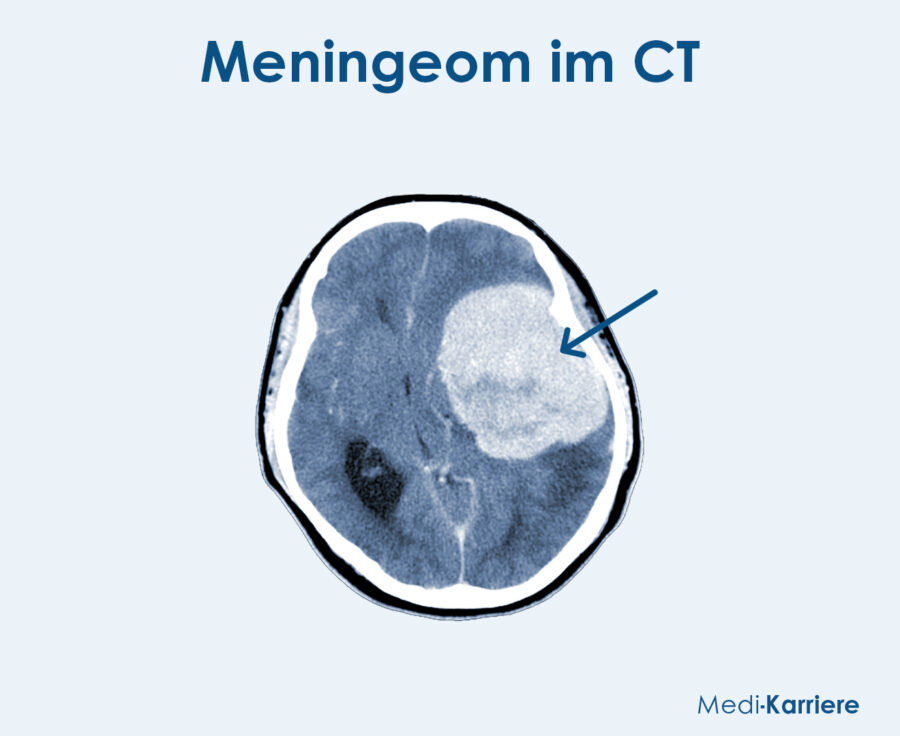 Meningeom Grafik