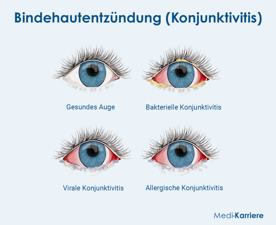 Grafik Bindehautentzündung