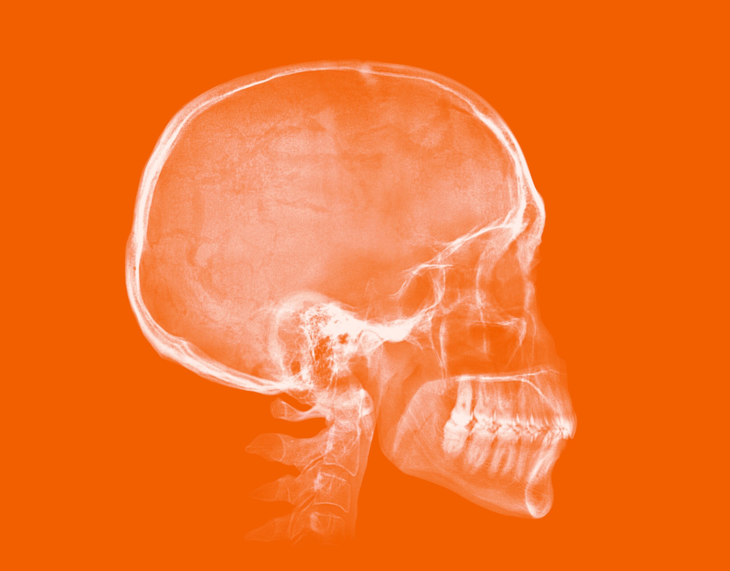 Human,Skull.,X Ray,Image,Isolated,On,Orange,Background