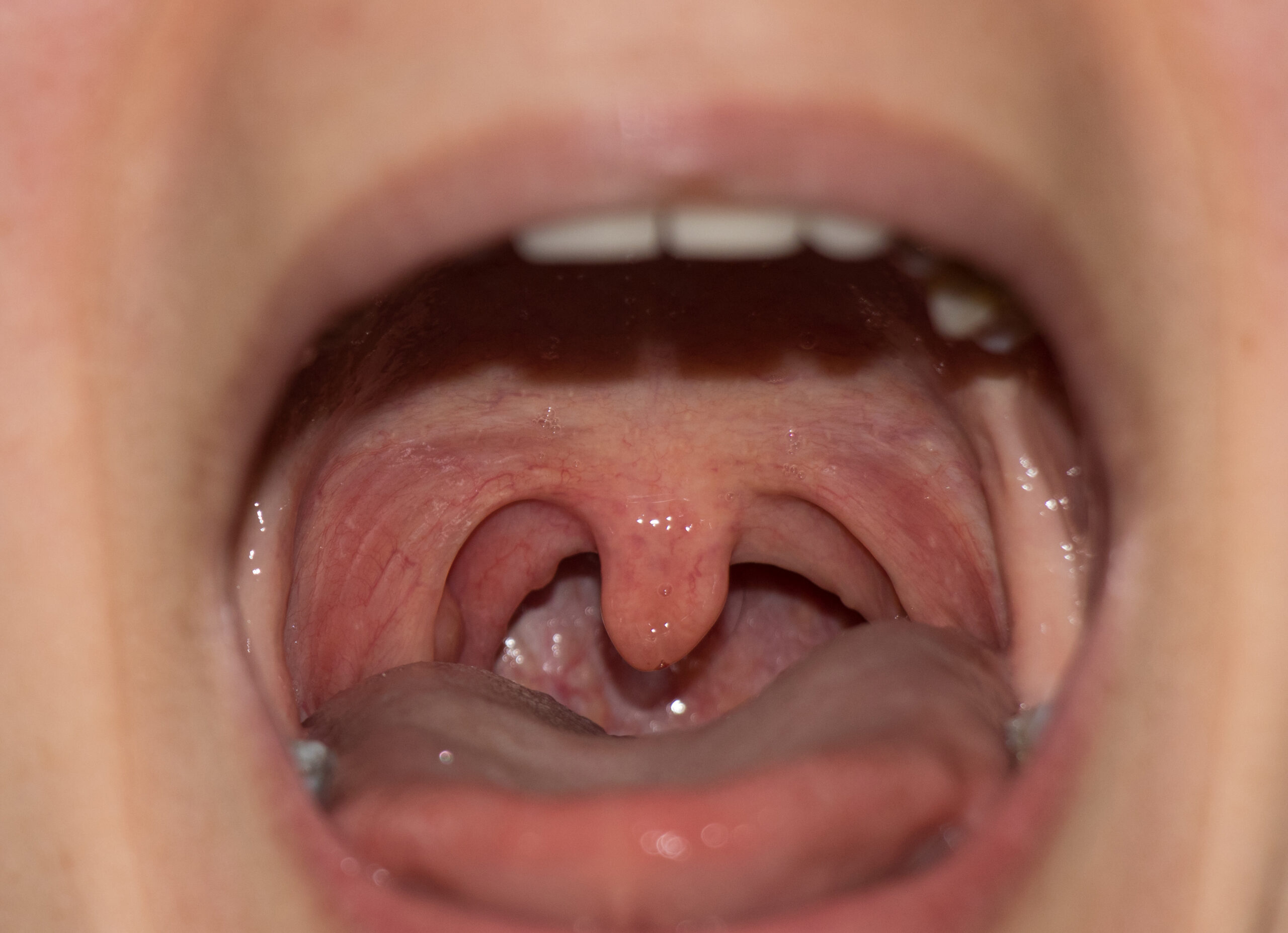 Closeup,View,Of,Open,Mouth,With,Tonsils