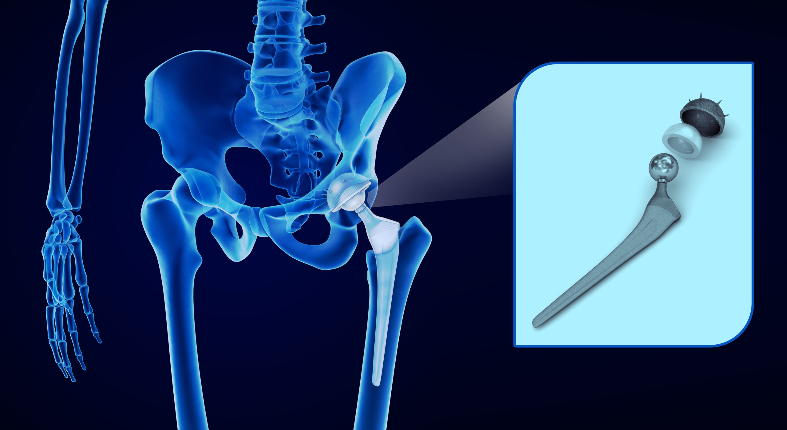 Hip,Replacement,Implant,Installed,In,The,Pelvis,Bone.,X Ray,View.