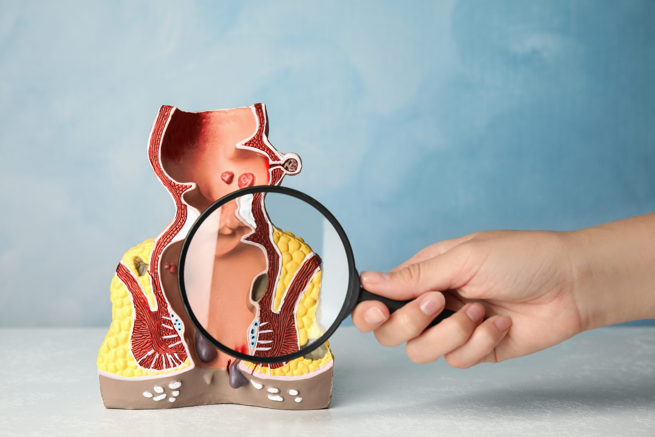 Doctor,With,Magnifying,Glass,Showing,Model,Of,Unhealthy,Lower,Rectum