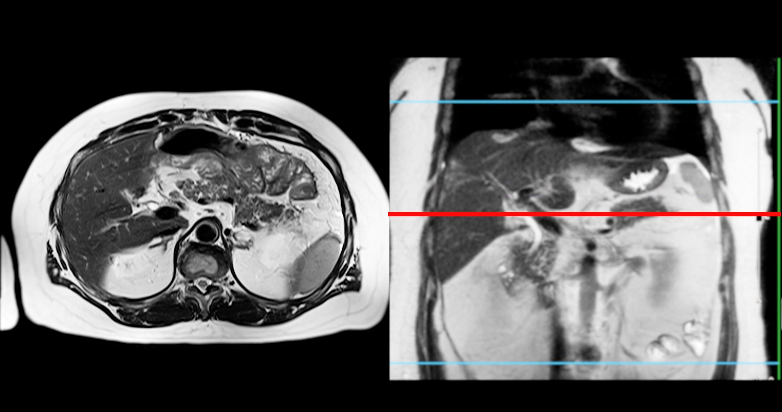 Mri,Of,The,Upper,Abdomen,Is,A,Non Invasive,Imaging,Technique