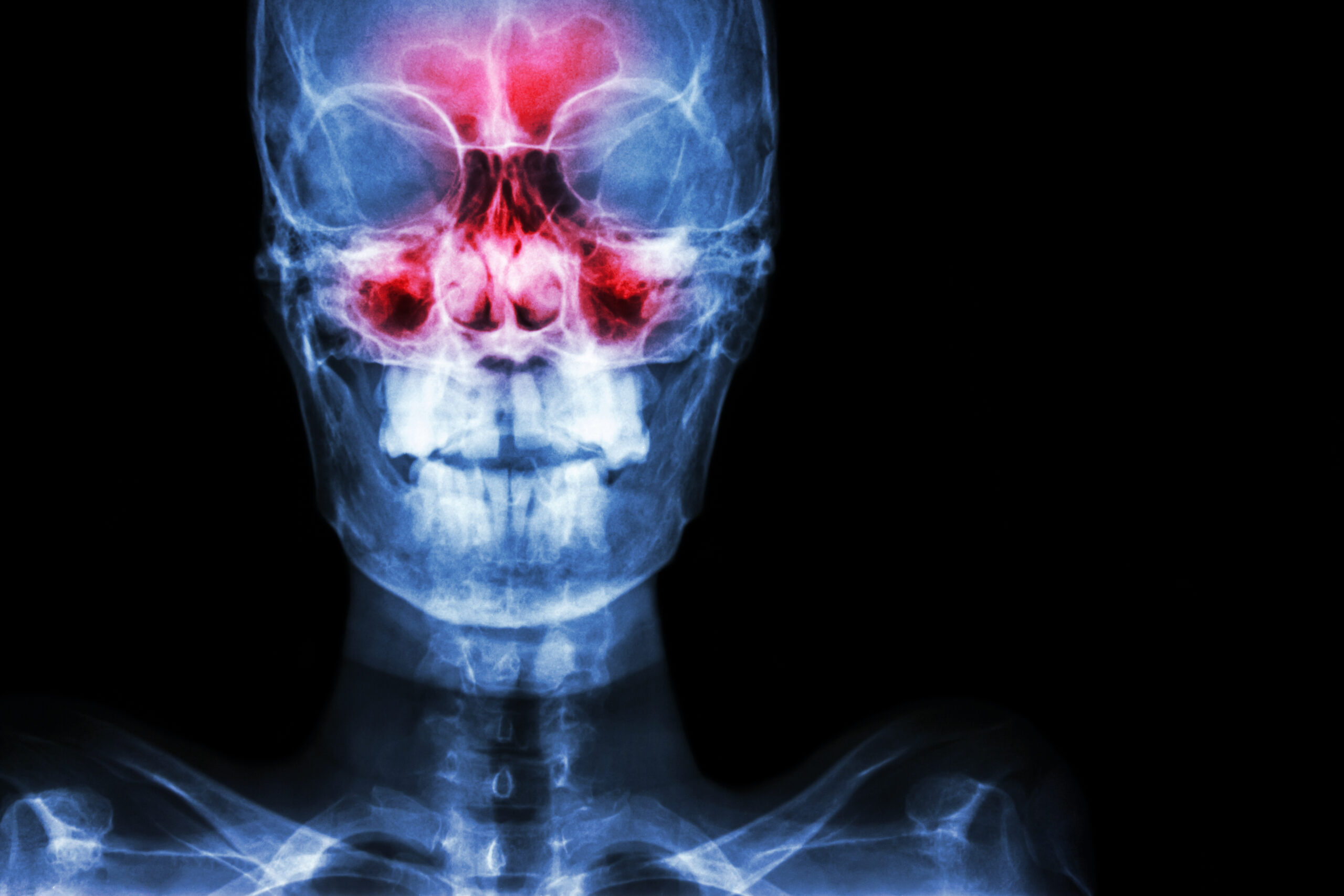 Sinusitis.,Film,X Ray,Skull,Ap,(,Anterior, ,Posterior,)