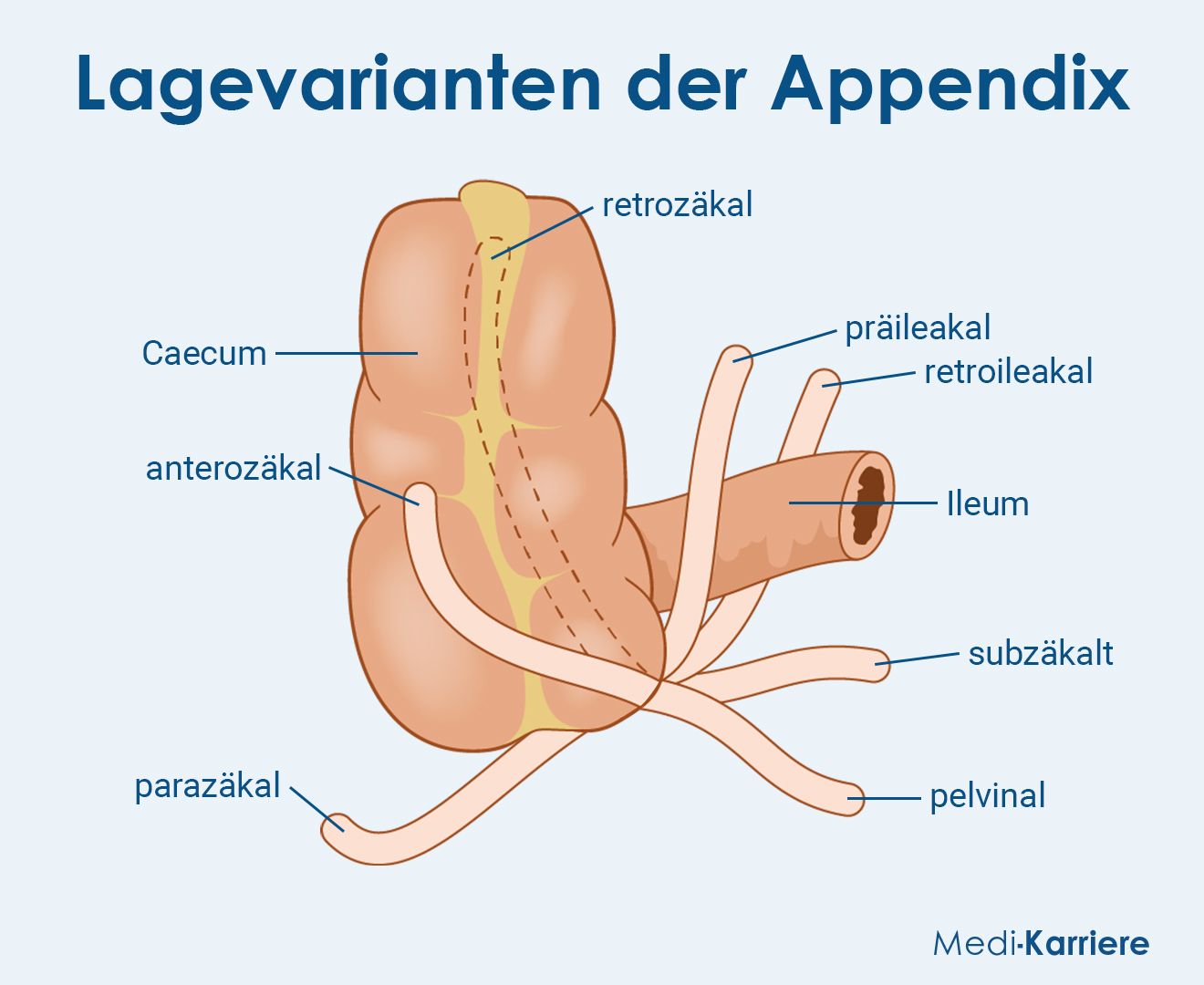 Appendix Vermiformis