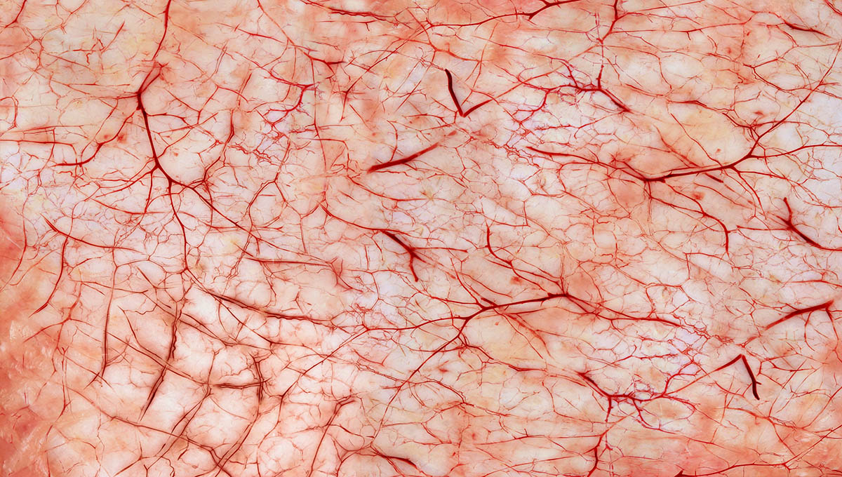 Red,Inflammatory,Capillaries,On,The,Skin.,Abstract,Network,Of,Vessels