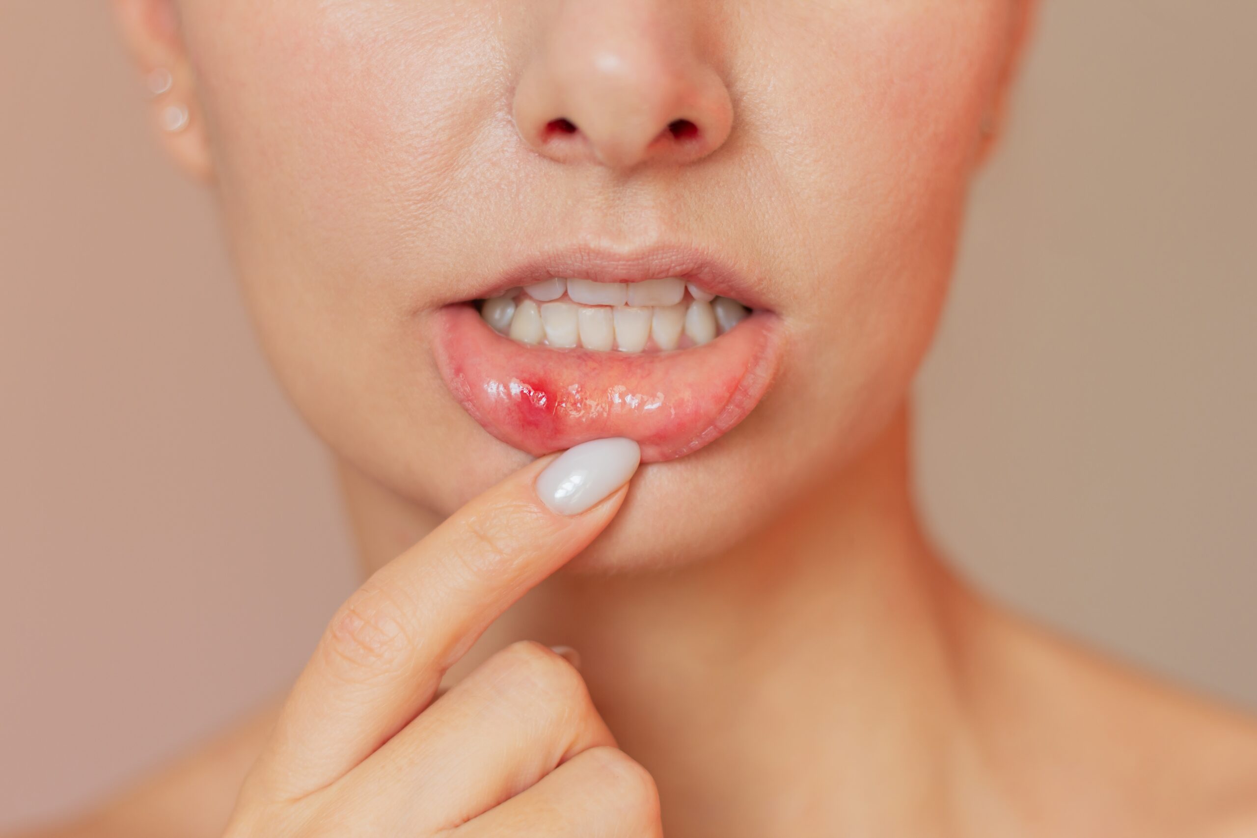 A,Young,Woman,Shows,A,Close Up,Of,A,Stomatitis,Ulcer