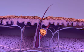 Formation,Of,Skin,Acne,Or,Pimple.,The,Sebum,In,The
