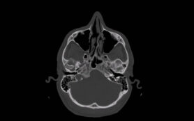 Ct,Scan,Of,Human,Paranasal,Sinuses,(axial,View,Computed,Tomography)