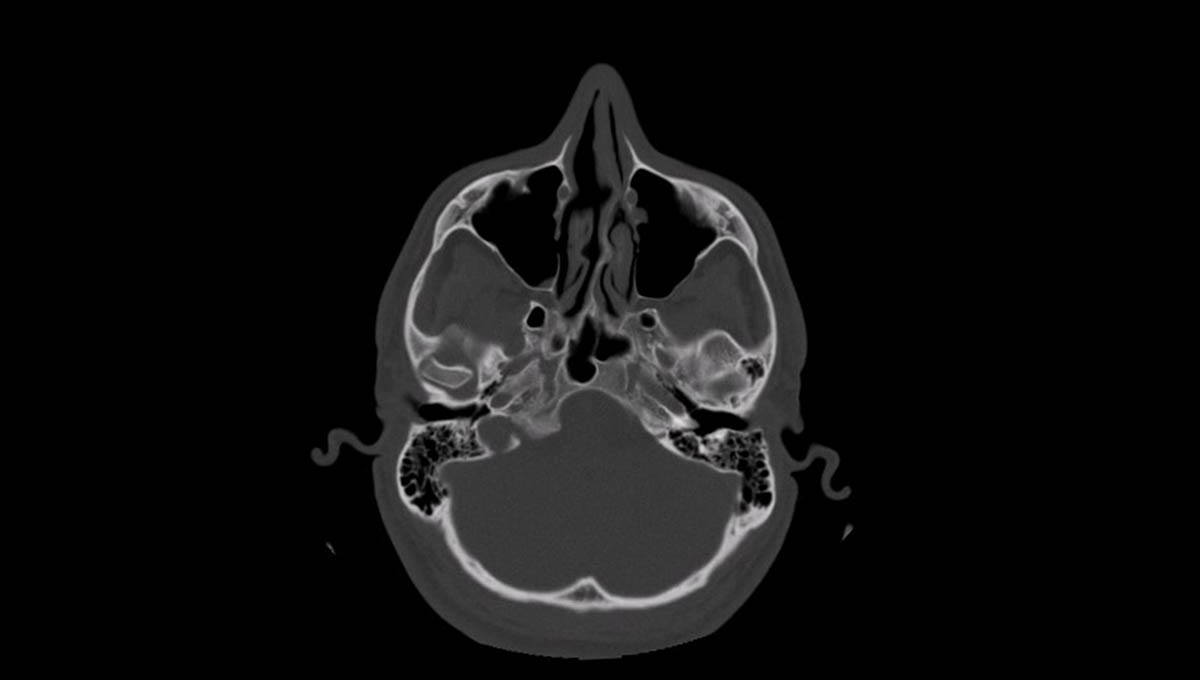 Ct,Scan,Of,Human,Paranasal,Sinuses,(axial,View,Computed,Tomography)