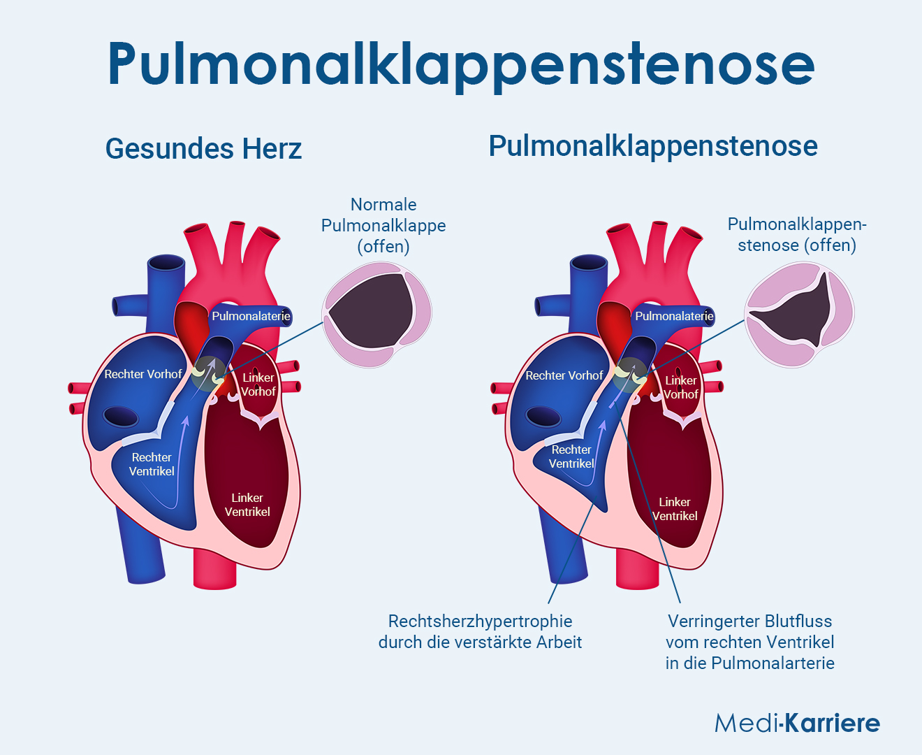 Pulmonalklappe Anatomie und Erkrankungen