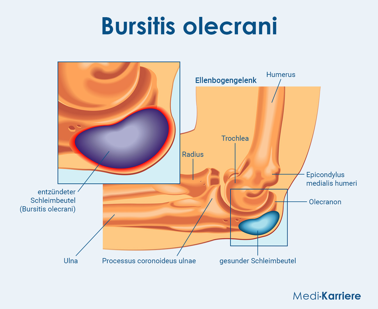 Schleimbeutel Bursa Einteilung Und Klinik Schleimbeutel Bursa Einteilung Und Klinik