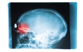 X Ray,Image,Of,Head,And,Brain,Skull,With,Red,Pain