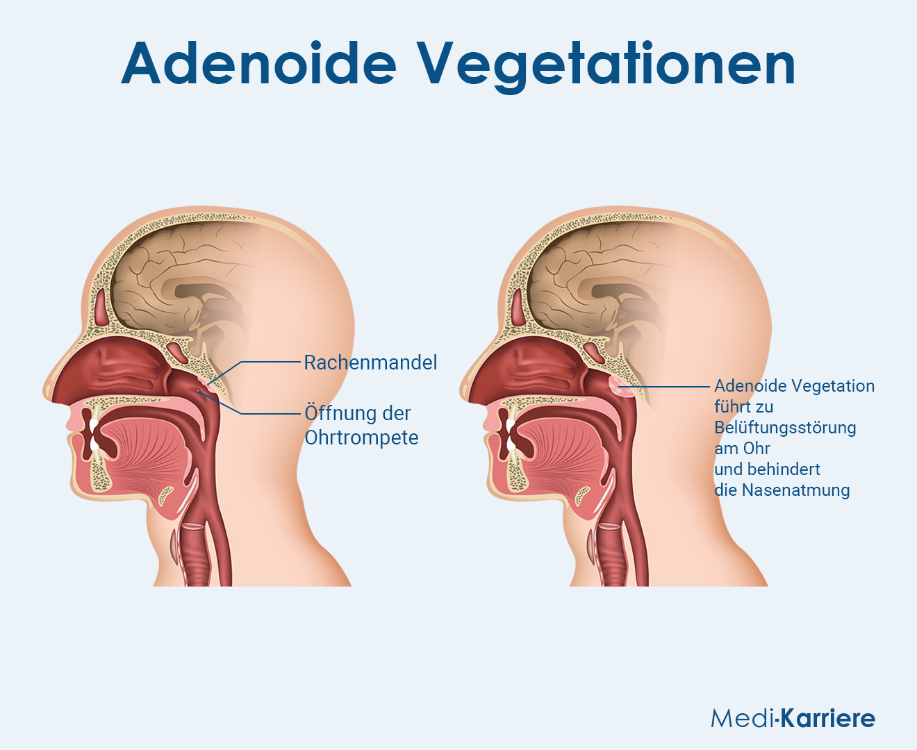 Adenoide Grafik