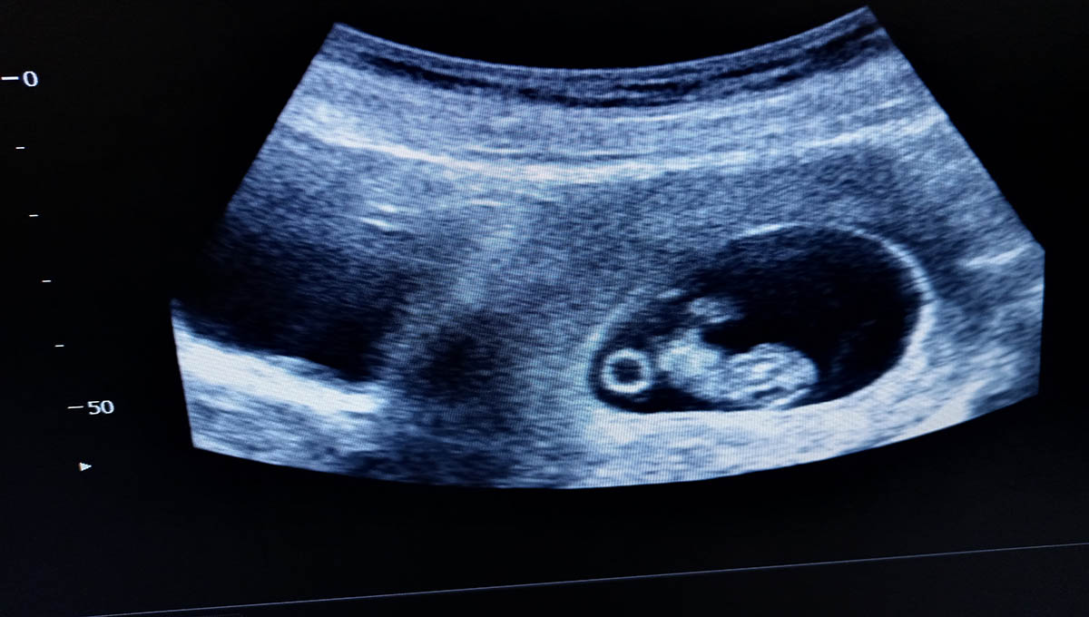 Yolk,Sac,Amniotic,Sac,Fetus,8,Weeks,By,Ultrasound,Scan