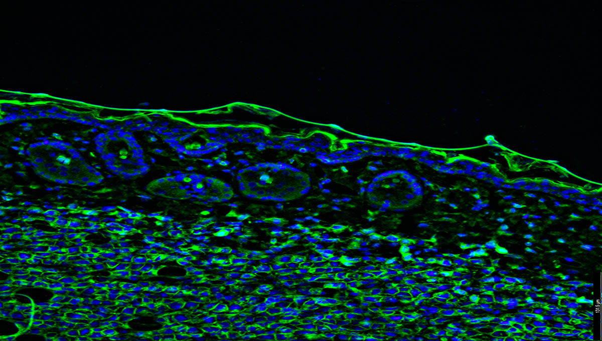 Tumour,Immunofluorescence,Ihc,Image.,Aggressive,Metastatic,Melanoma,Tumor,Cells,In