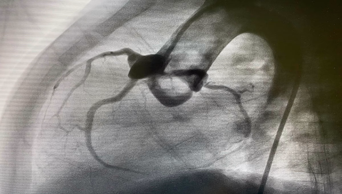 Aortogram,Of,Children,With,Tetralogy,Of,Fallot,Disease,(tof),Was