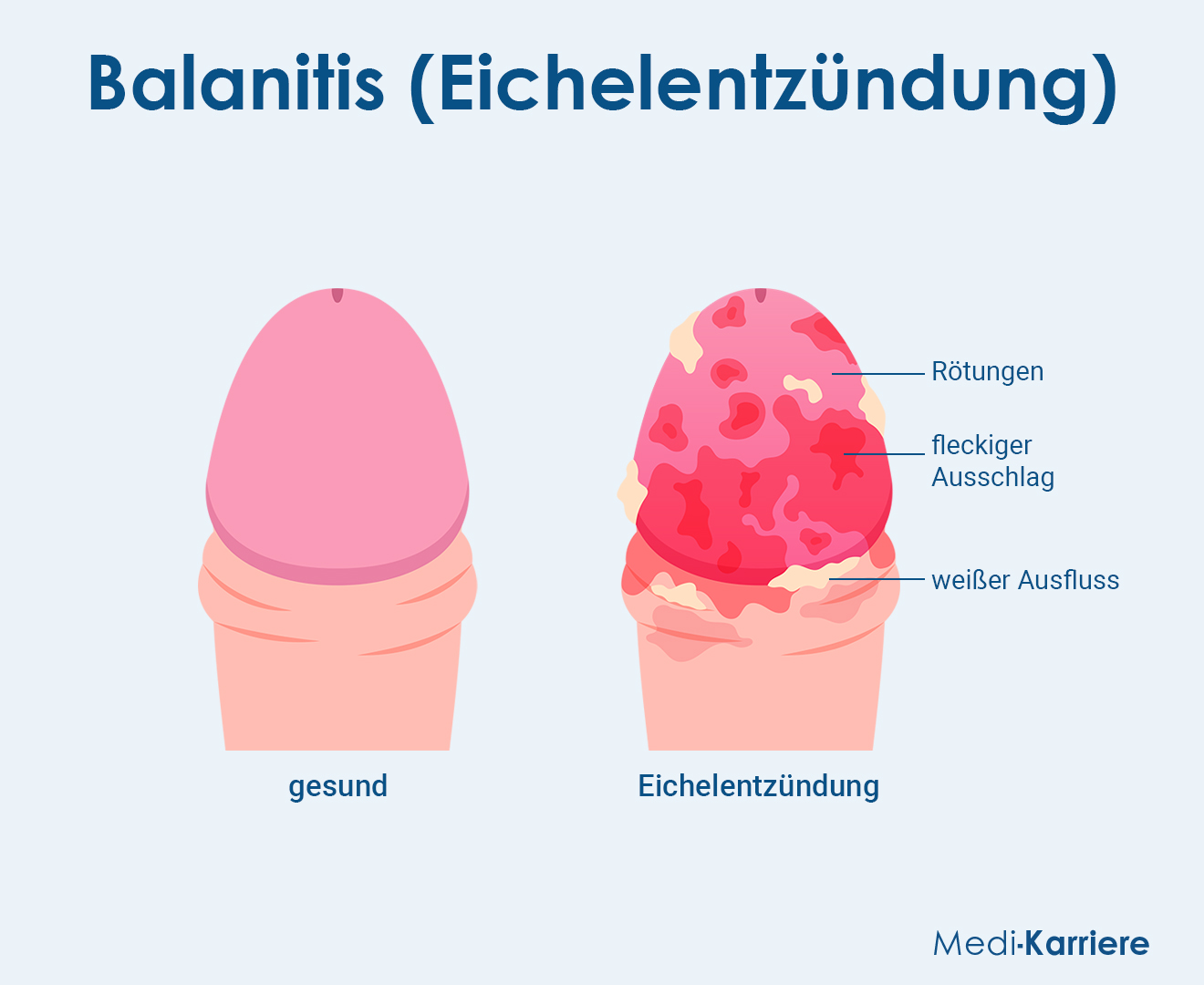 Smegma Grafik