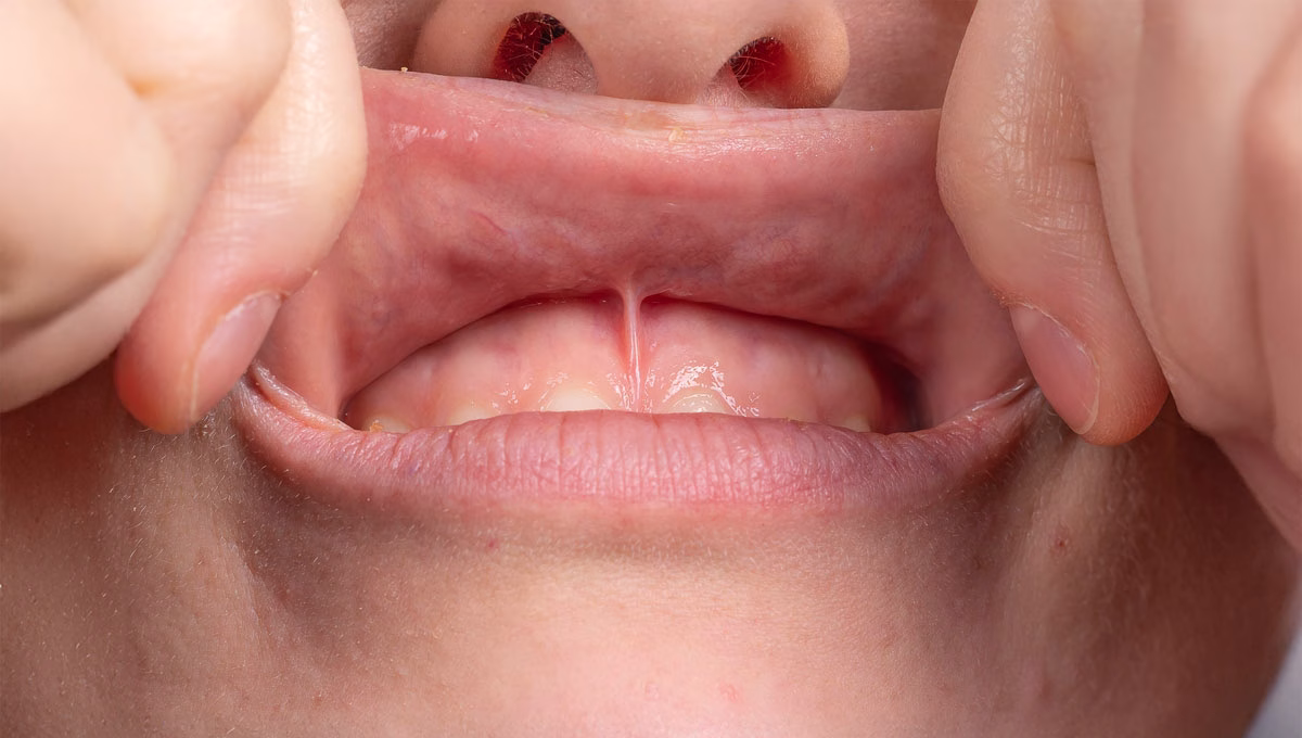 Medical,Inspection,Of,The,Superior,Labial,Frenulum,To,Evaluate,The