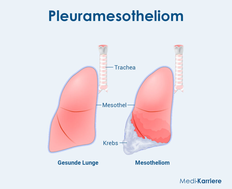 Mesothel Grafik
