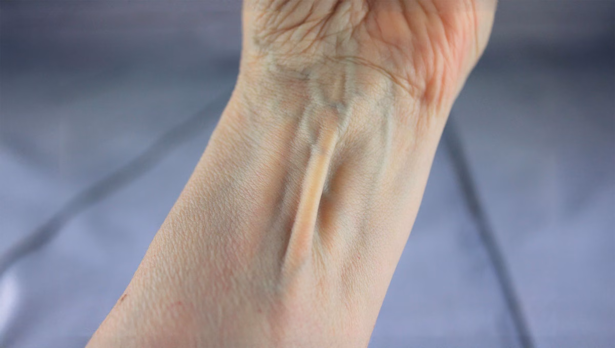 Palmaris,Longus,Muscle,,Visible,Tendon,Located,Between,The,Flexor,Carpi