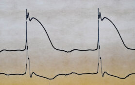 Historical,Registration,Of,Monophasic,Action,Potentials,From,The,Human,Heart
