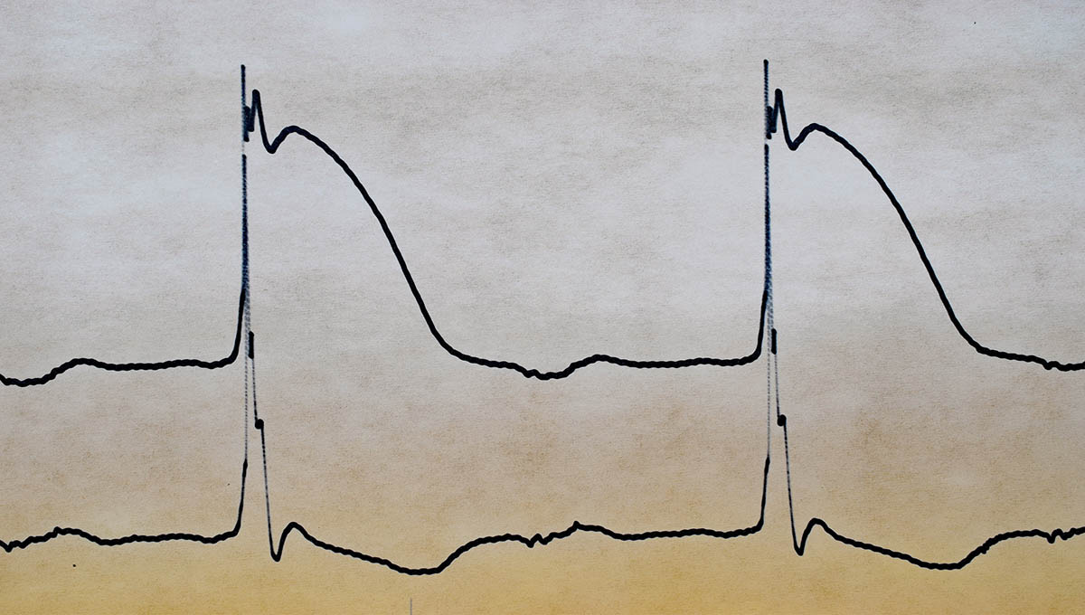 Historical,Registration,Of,Monophasic,Action,Potentials,From,The,Human,Heart