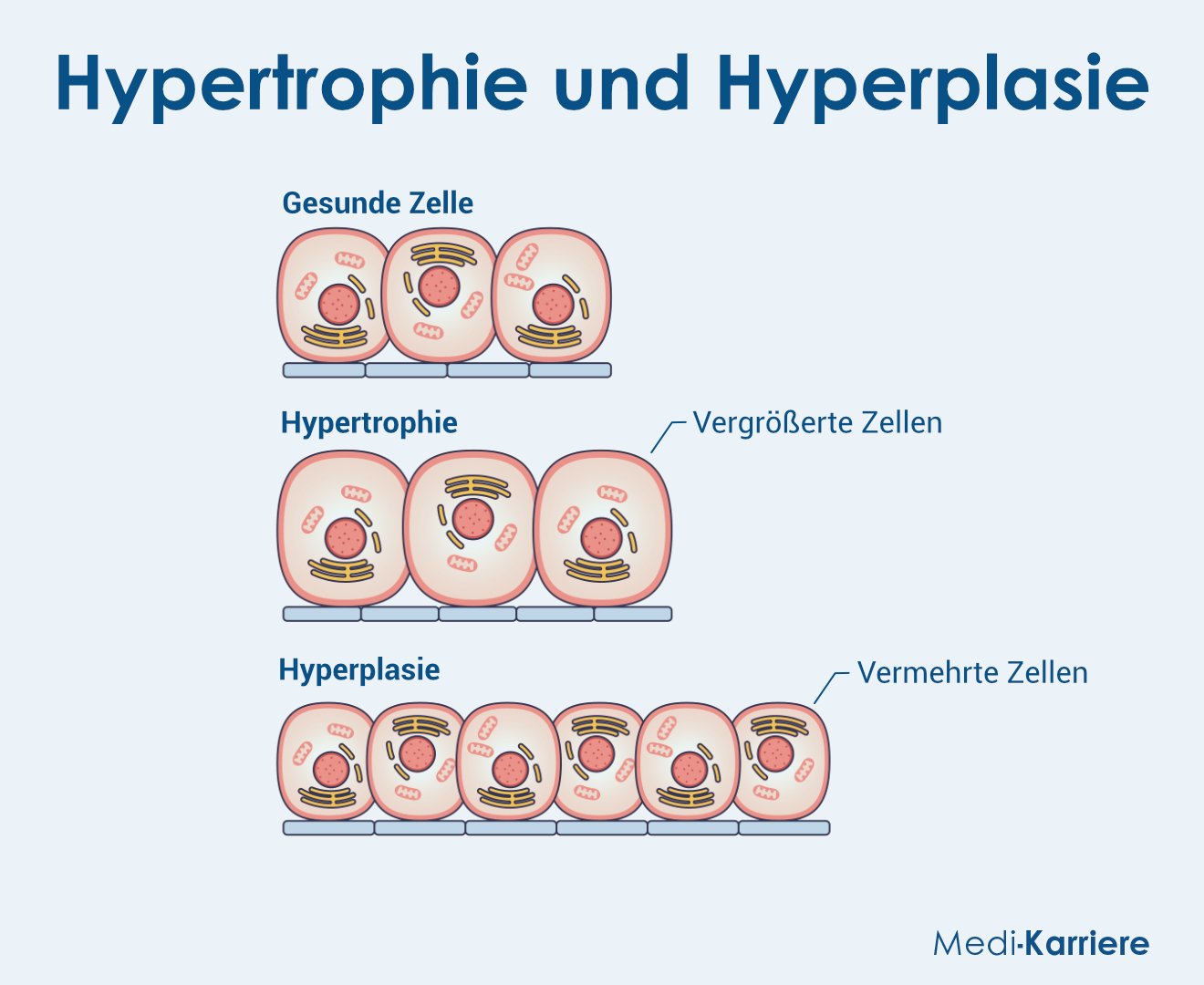 Hypertrophie Grafik
