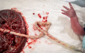 A,Closeup,Of,A,Human,Placenta,And,A,Newborn,Child'd
