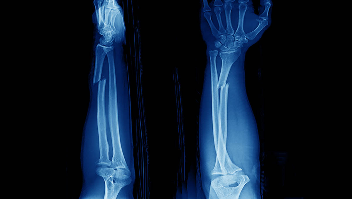 X Ray,Of,Forearm,And,Wrist,Showing,Closed,Fracture,At,Distal