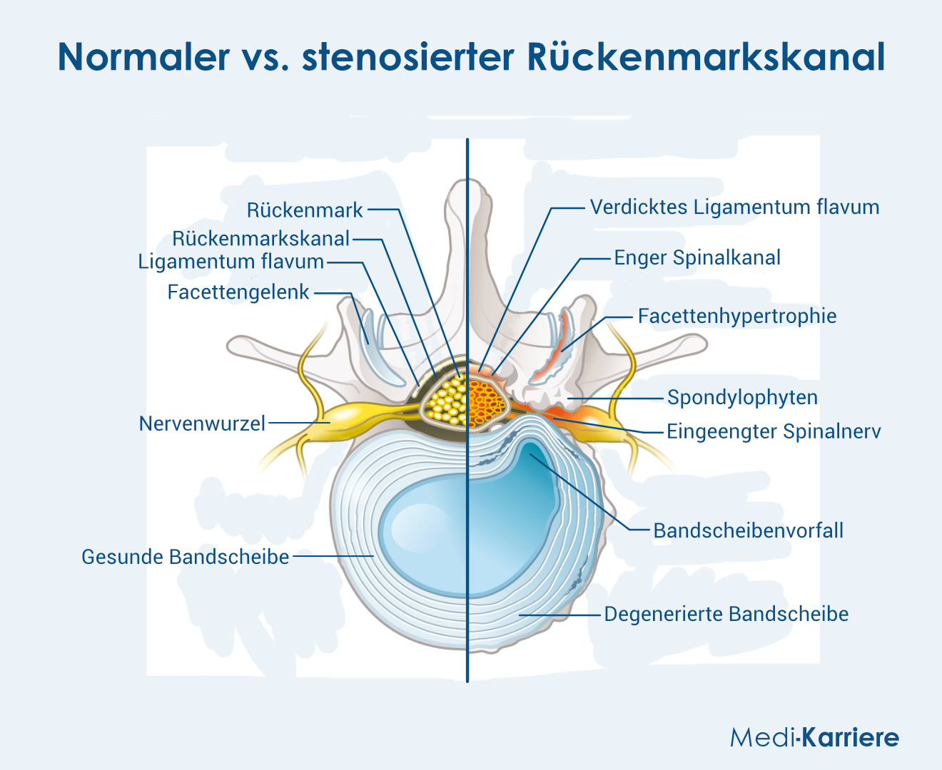 Rückenmarkskanal Grafik