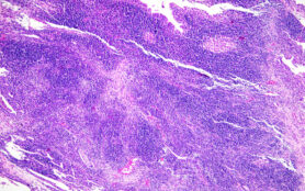 This,Is,A,Pathological,Picture,Of,Human,Left,Ventricular,Hypertrophy,