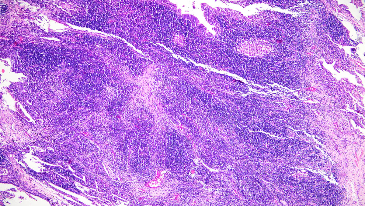 This,Is,A,Pathological,Picture,Of,Human,Left,Ventricular,Hypertrophy,