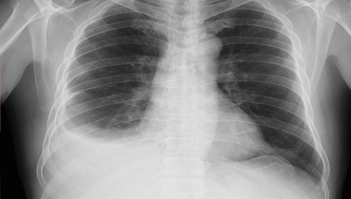 Pleural,Effusion,In,Chest,X Ray,,A,Pleural,Effusion,Is,A