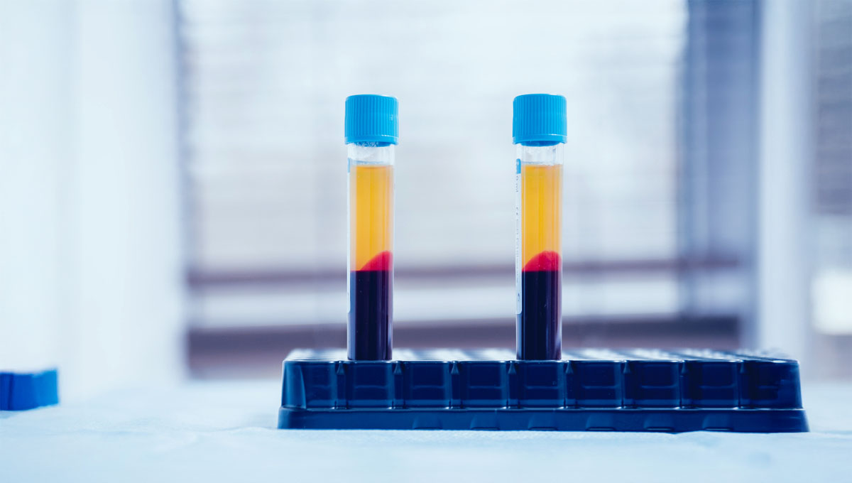Platelet Rich,Plasma,Preparation.,Plasma,In,Syringe.,Centrifuge.,Background