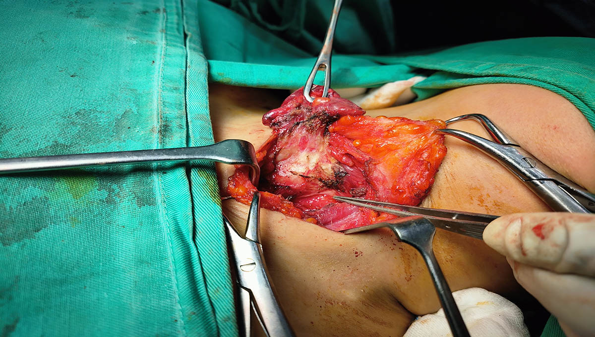 Surgeon,Performing,Operation,On,Thyroid,Gland.,Recurrent,Laryngeal,Nerve,Preserved.