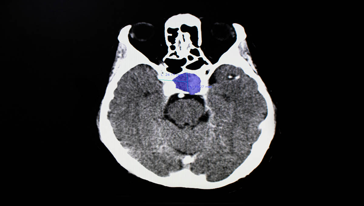 Ct,Brain,Scan,Of,A,Patient,With,Pituitary,Tumor,Showing
