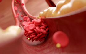 High,Cholesterol,And,Fatty,Acids,In,Blood,Cells,Causing,Blood