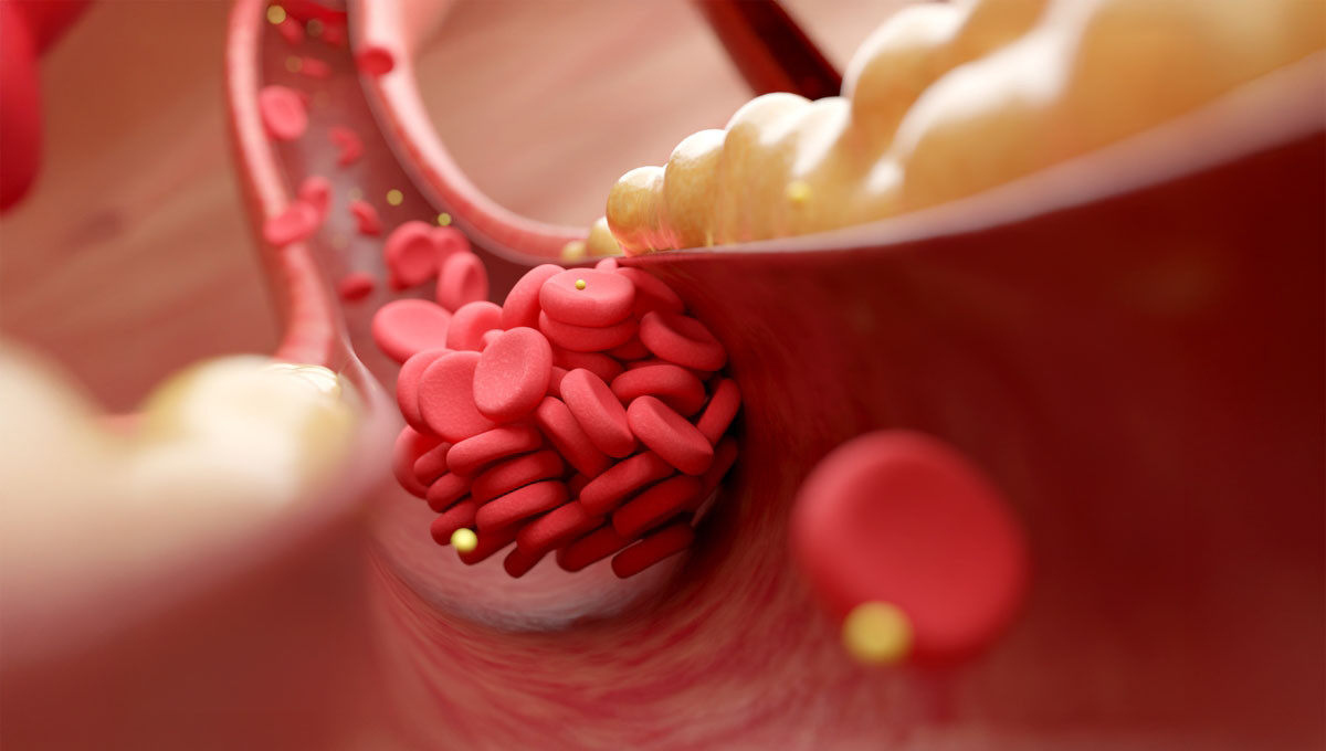 High,Cholesterol,And,Fatty,Acids,In,Blood,Cells,Causing,Blood