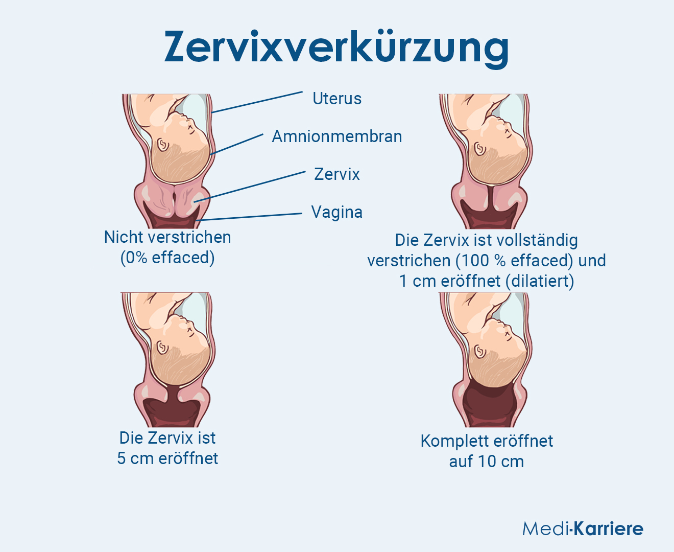 Zervixverkürzung